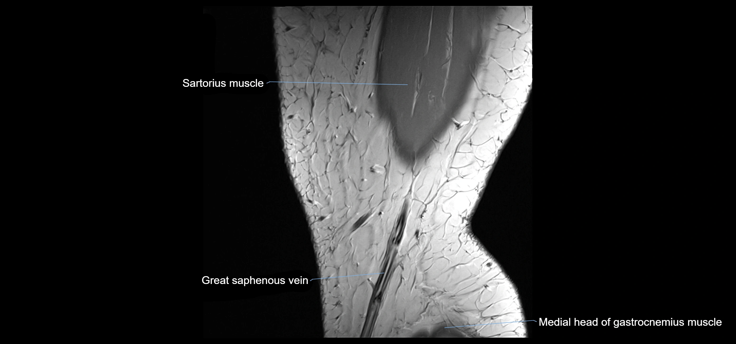 MRI knee sagittal cross sectional anatomy labelled 3T radiology image-00001.webp